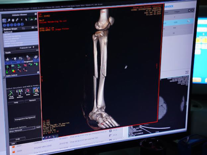 Phim chụp tổn thương chân của cầu thủ Xuân Son. Ảnh: BVCC